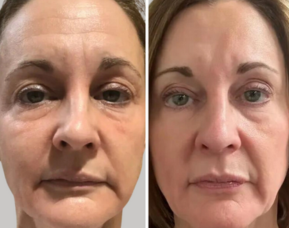 Omnilux Contour Face - Red Light Therapy Mask